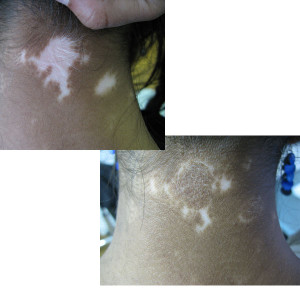 vitiligo-web